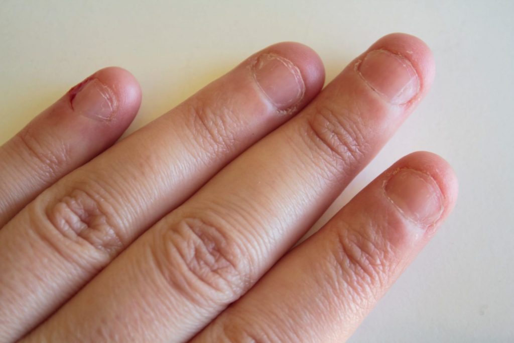 la manucure adaptée à vos ongles rongés.