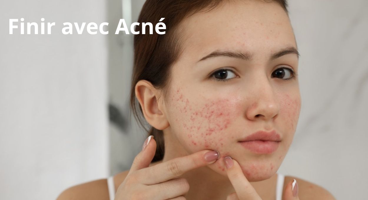 Astuces pour Astuces efficaces pour se débarrasser de l'Acné naturellement